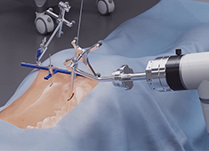 骨科手術機器人收費標準:導航功能2000元封頂