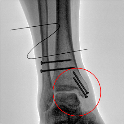 【醫(yī)療科普】之內踝骨折